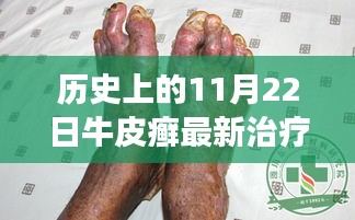 揭秘，牛皮癣最新治疗方法的演变与影响——以11月22日的历史革新为视角