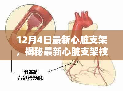 揭秘心脏守护者，最新心脏支架技术解析（12月4日更新）