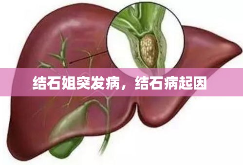 结石姐突发病，结石病起因 