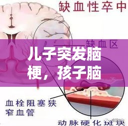 儿子突发脑梗，孩子脑梗死什么原因造成的 